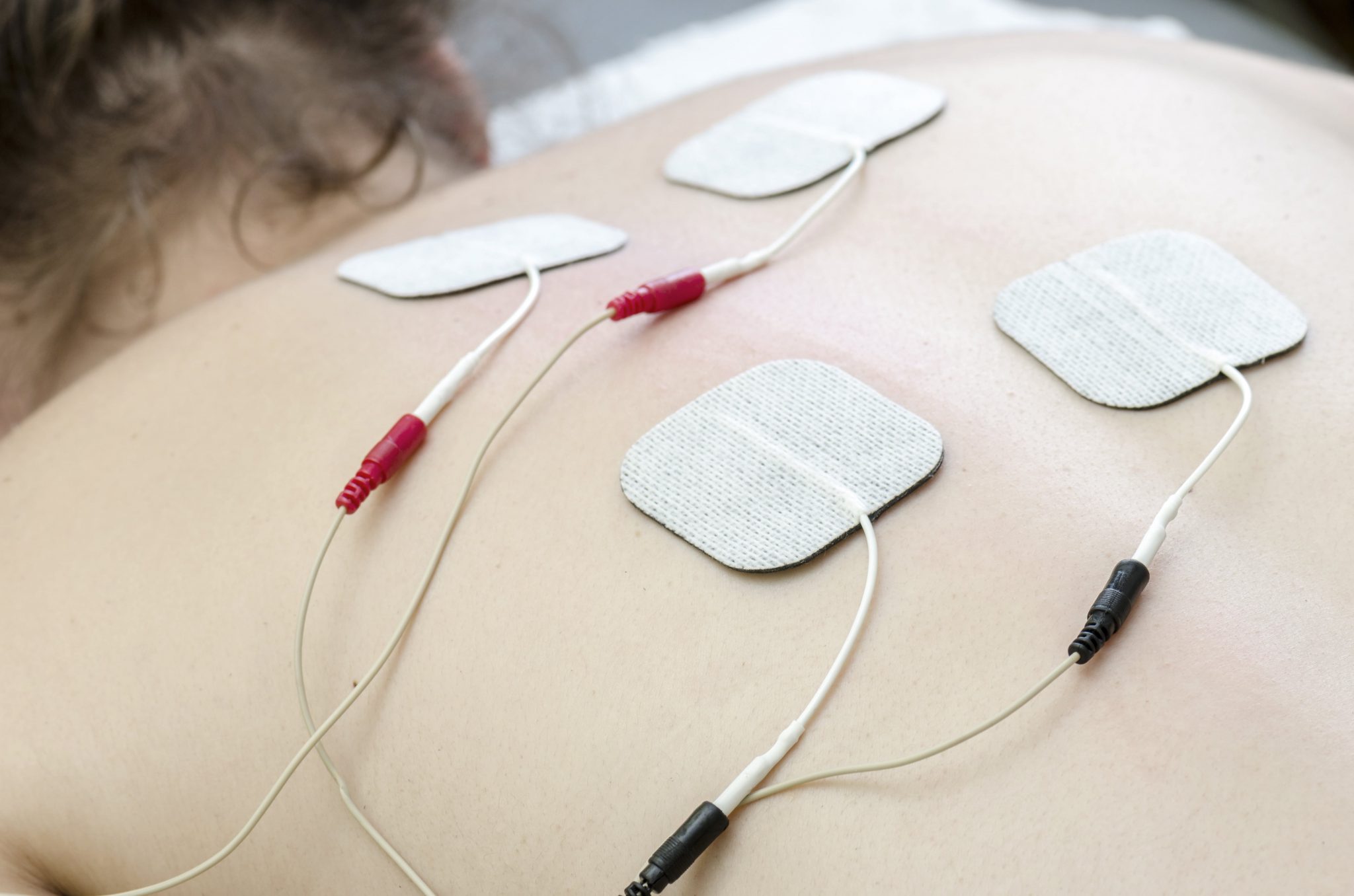 Transkutane Elektr. Nervenstimulation – Schmerzzentrum Frankfurt